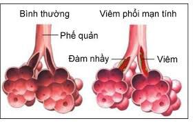 cach-phong-ngua-cac-benh-duong-ho-hap-de-mac